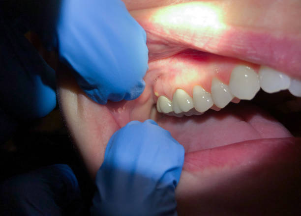 Best Emergency Dental Care for Broken or Chipped Teeth in Sunny Isles Beach, FL
